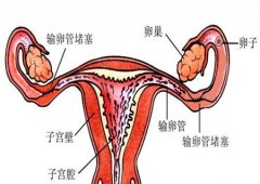 不孕症的输卵管原因有哪些